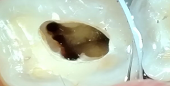 下頜第一磨牙MM根管一例。
